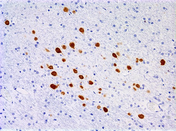 1A2 Microdysgenesis (Case 1)  WM NeuN 3