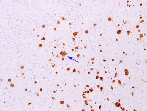 1A3 Microdysgenesis (Case 1) WM NeuN 5