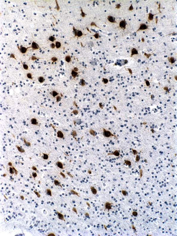 2A2 Microdysgenesis (Case 2) WM NeuN 1