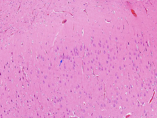 3A1 Microdysgenesis (Case 3) H&E 2