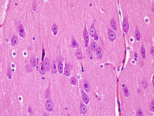 3A2 Microdysgenesis (Case 3) H&E 1