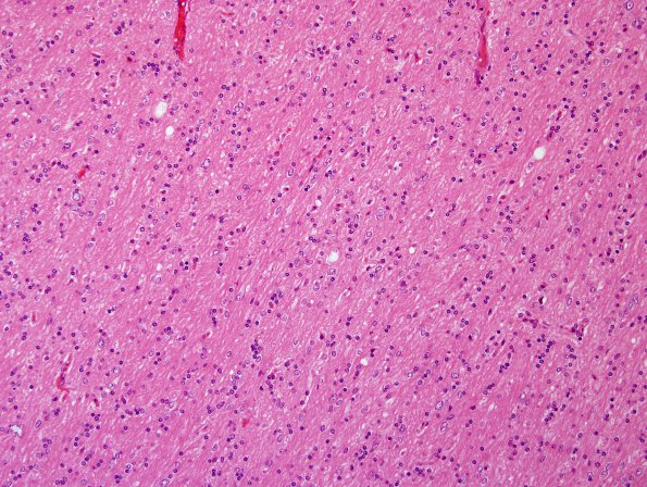 5A1 Microdysgenesis (Case 5) H&E WM 4