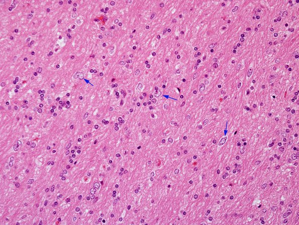 5A3 Microdysgenesis (Case 5) H&E WM 1