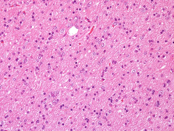 5A4 Microdysgenesis (Case 5) H&E 4