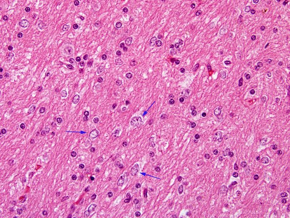 5A5 Microdysgenesis (Case 5) H&E WM 3