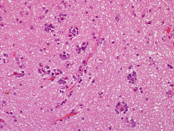 5A6 Microdysgenesis (Case 5) H&E 1