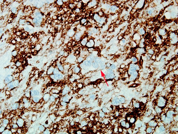 5B3 Microdysgenesis (Case 5) CD34 WM 6