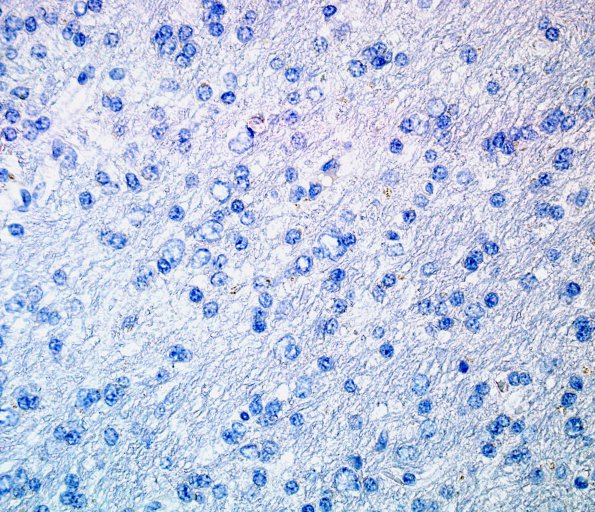 5B7 Microdysgenesis (Case 5) mutant IDH1 R132H) 2