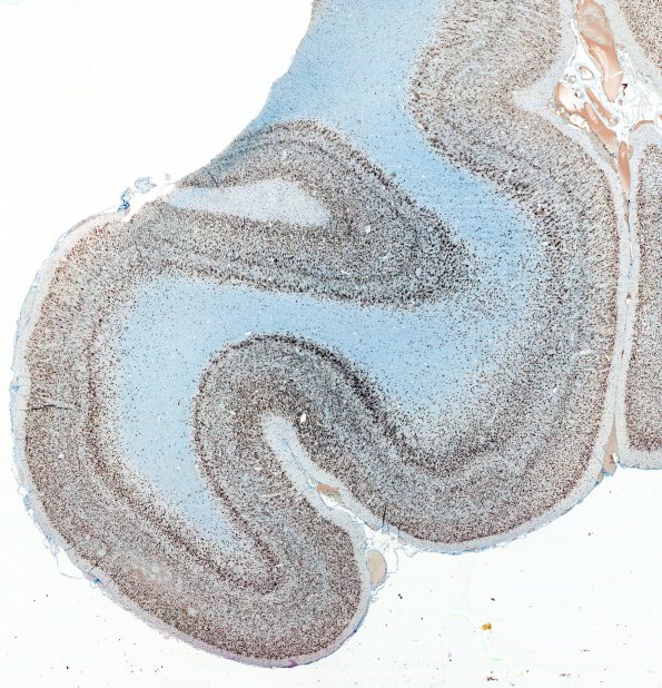 6 Microdysgenesis (Case 6)  NeuN