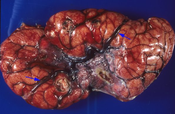 1A1 Infarct, Congenital Heart Dz chronic seizures (CHD, less than 1 year of age producing Chronic Sz Disorder (Case 1) 1