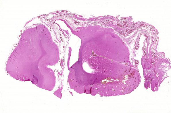 1B1 Pseudo AVM (Case 1) H&E 1