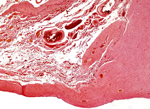 1B4 PseudoAVM (Case 1) H&E 6