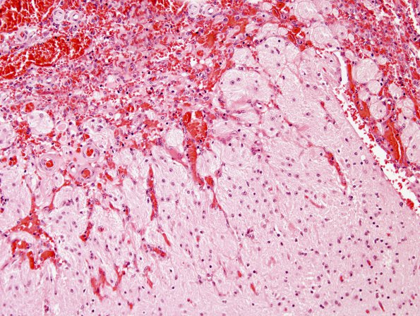 1B5 PseudoAVM (Case 1) H&E 8