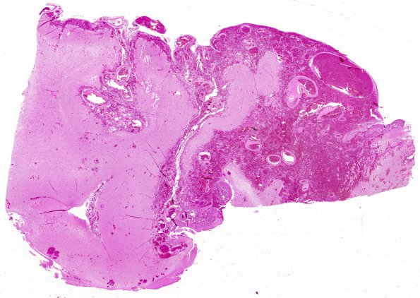 1D PseudoAVM (Case 1) 2 H&E 1