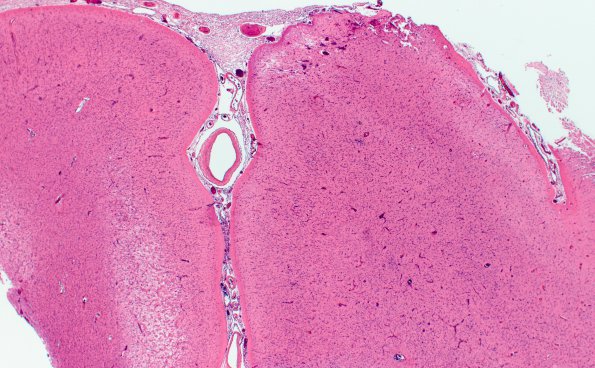 10A1 Rasmussens (Case 10) H&E 8