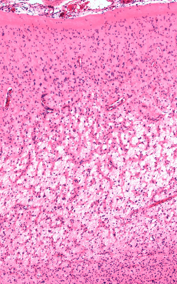 10A2 Rasmussens (Case 10) H&E 7