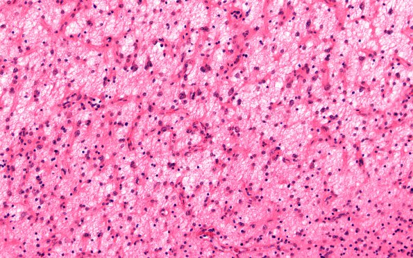 10A3 Rasmussens (Case 10) H&E 5