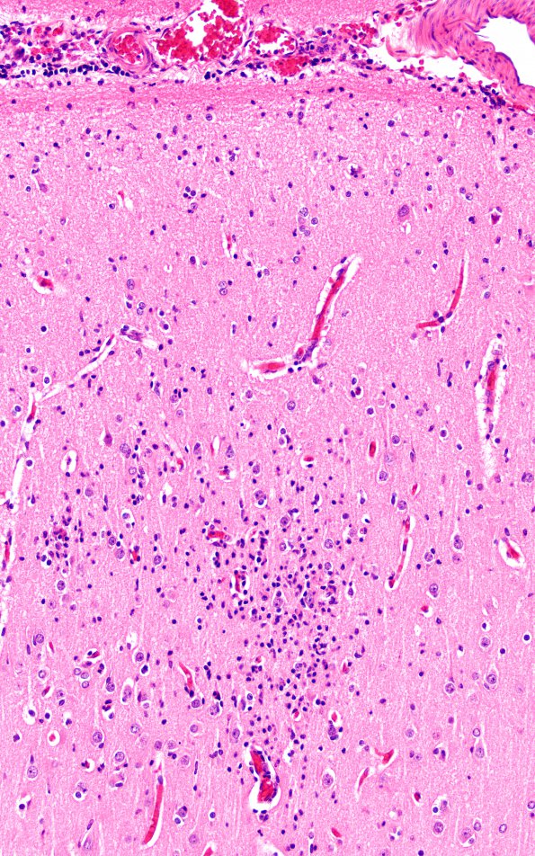 11A1 Rasmussens (Case 11) H&E 20X 2