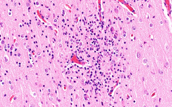 11A2 Rasmussens (Case 11) H&E 40X 4