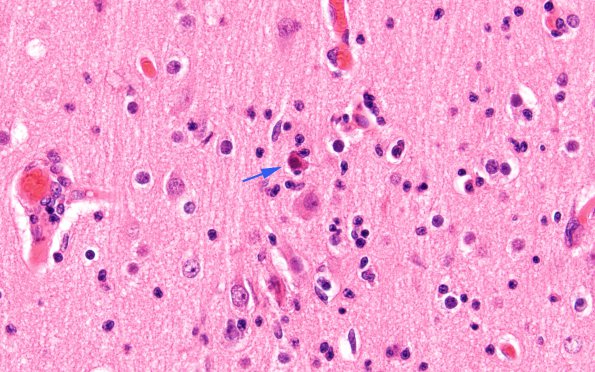 11A4 Rasmussens (Case 11) H&E 60X copy