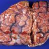 1A1 Rasmussen's Chronic Encephalitis (Case 1) 1