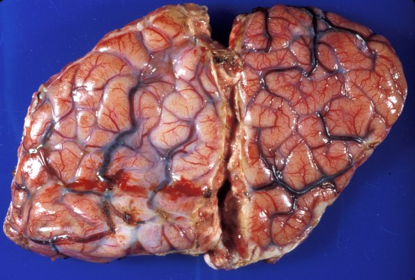 1A1 Rasmussen's Chronic Encephalitis (Case 1) 1