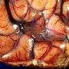 1A2 Rasmussen's Chronic Encephalitis (Case 1) 4