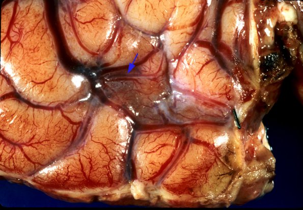 1A2 Rasmussen's Chronic Encephalitis (Case 1) 4