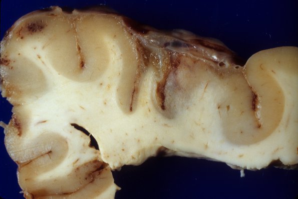 1A3 Rasmussen's Chronic Encephalitis (Case 1) 5