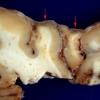 1A4 Rasmussen's Chronic Encephalitis (Case 1) 6