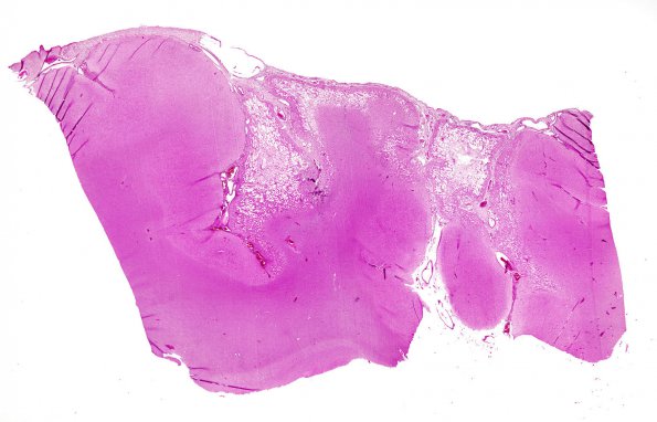 1B1 Rasmussens Chronic Enceph (Case 1) H&E whole mount 2