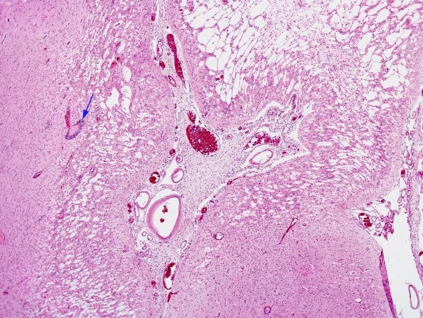 1B2 Rasmussens Chronic Enceph (Case 1) H&E 4