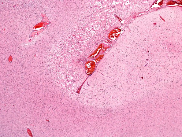 1B3 Rasmussens Chronic Enceph (Case 1) H&E 2