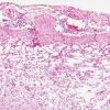 1B4 Rasmussens Chronic Enceph (Case 1) H&E 11