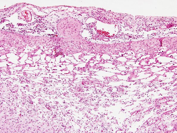 1B4 Rasmussens Chronic Enceph (Case 1) H&E 11