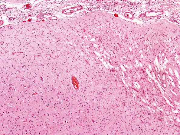 1B5 Rasmussens Chronic Enceph (Case 1) H&E 1