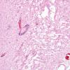 1B6 Rasmussens Chronic Enceph (Case 1) H&E 5