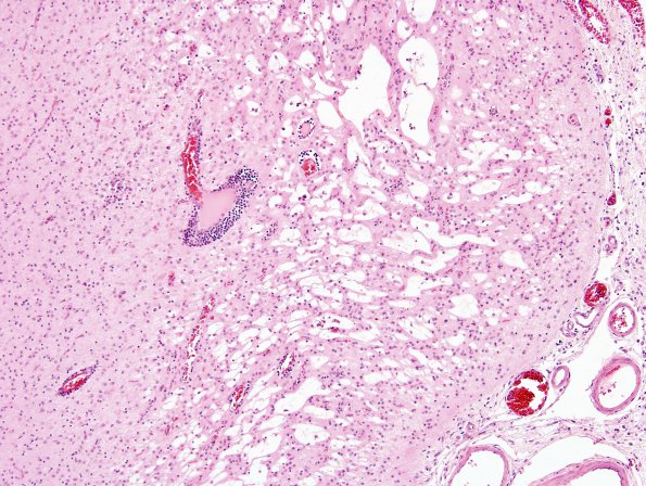 1B6 Rasmussens Chronic Enceph (Case 1) H&E 5