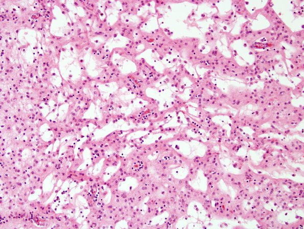 1B7 Rasmussens Chronic Enceph (Case 1) H&E 8