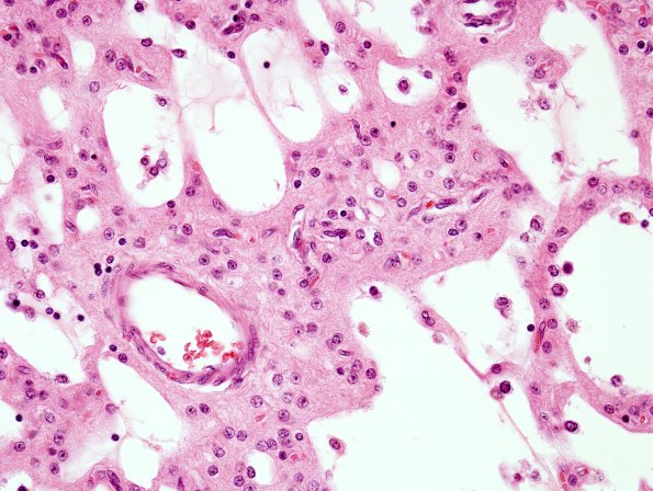 1B8 Rasmussens Chronic Enceph (Case 1) H&E 6