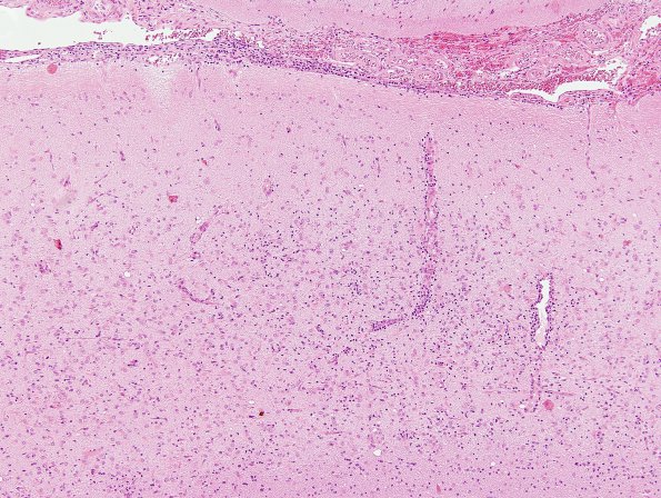 2A1 Rasmussens Chronic Encephalitis (Case 2) H&E 10