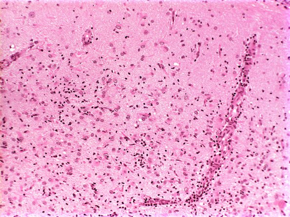 2A2 Rasmussens Chronic Enceph (Case 2) H&E 1