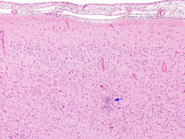 2A3 Rasmussens Chronic Encephalitis (Case 2) H&E 13