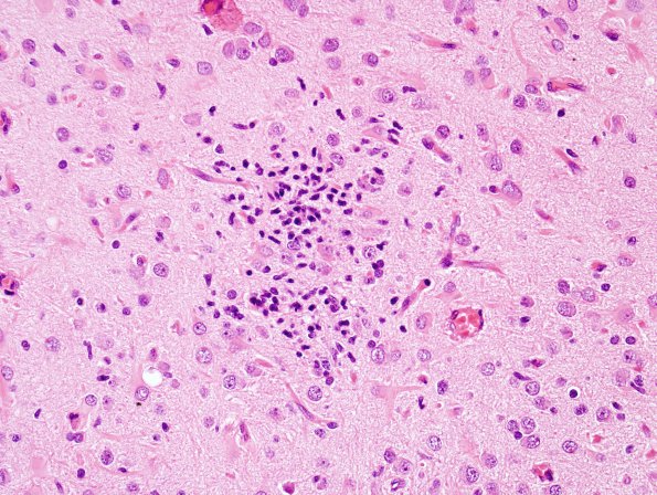 2A4 Rasmussens Chronic Encephalitis (Case 2) H&E 15A