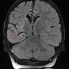 3A1 Rasmussen Encephalitis (Case 3) FLAIR COR FS - Copy