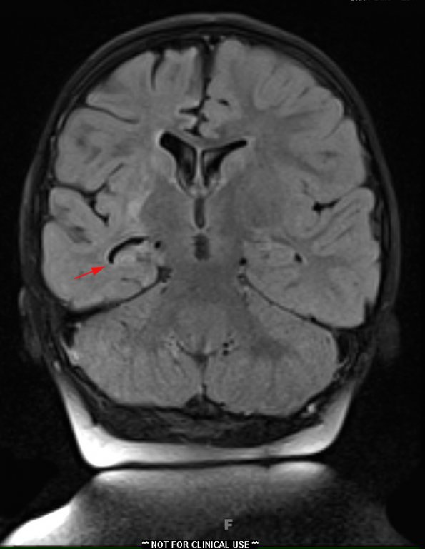 3A1 Rasmussen Encephalitis (Case 3) FLAIR COR FS - Copy