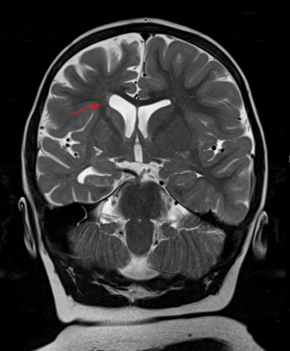 3A2 Rasmussen Encephalitis (Case 3) T2 TSE COR 512 3mm 6 - Copy