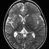 3A3 Rasmussen Encephalitis (Case 3) T2 TSE COR 512 3mm 3 - Copy