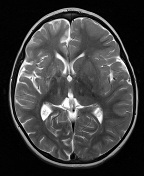 3A3 Rasmussen Encephalitis (Case 3) T2 TSE COR 512 3mm 3 - Copy