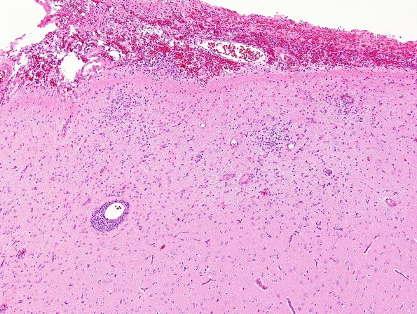 3B1 Rasmussen Encephalitis (Case 3) H&E 5